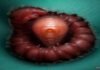 Worms mate in man's eyes, get plucked out right before larvae burst out Worms mate in man's eyes, get plucked out right before larvae burst out