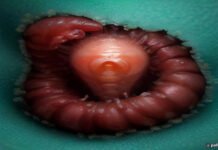 Worms mate in man's eyes, get plucked out right before larvae burst out Worms mate in man's eyes, get plucked out right before larvae burst out