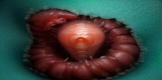 Worms mate in man's eyes, get plucked out right before larvae burst out Worms mate in man's eyes, get plucked out right before larvae burst out